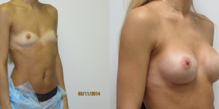 Увеличение груди до после – фото 33