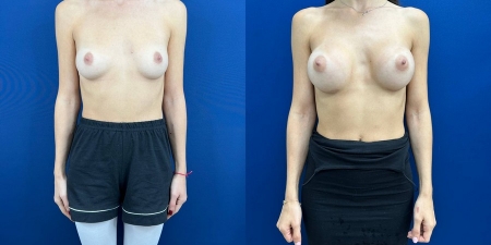 Увеличение груди до после – фото 40