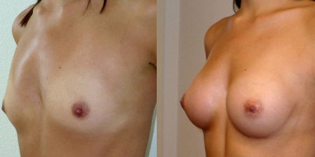 Увеличение груди до после – фото 58