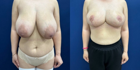 Увеличение груди до после – фото 43
