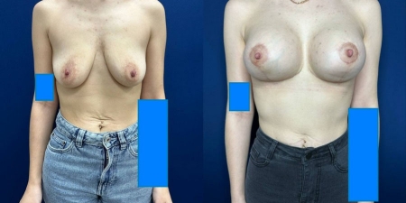 Увеличение груди до после – фото 36