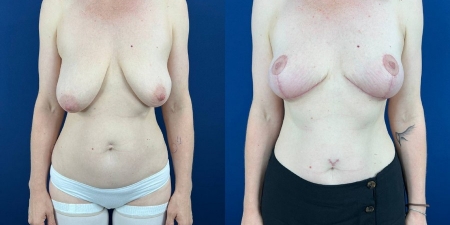 Увеличение груди до после – фото 71