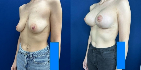 Увеличение груди до после – фото 35