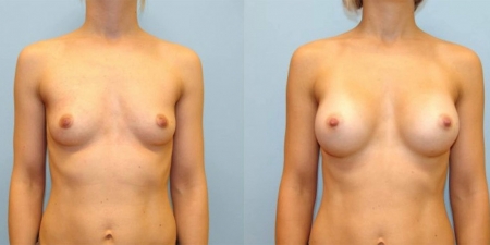 Увеличение груди до после – фото 60