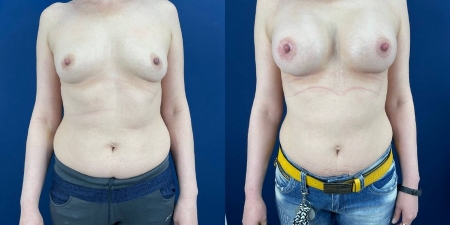 Увеличение груди до после – фото 6