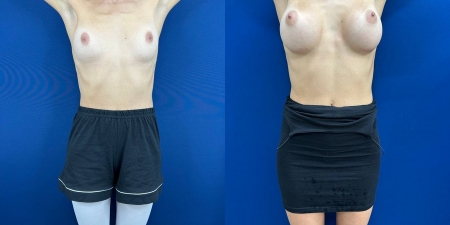Увеличение груди до после – фото 41