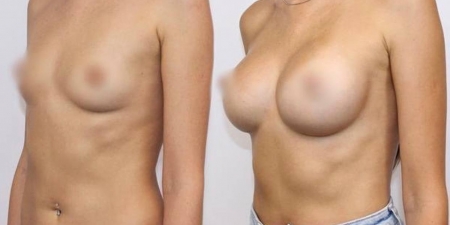 Увеличение груди до после – фото 63
