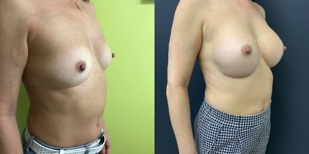 Увеличение груди до после – фото 13