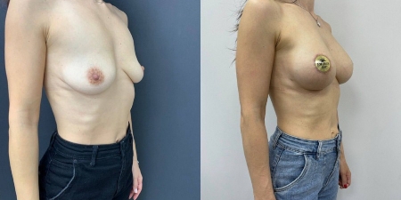 Увеличение груди до после – фото 10