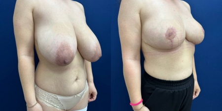 Увеличение груди до после – фото 44