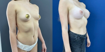 Увеличение груди до после – фото 14