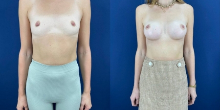 Увеличение груди до после – фото 75