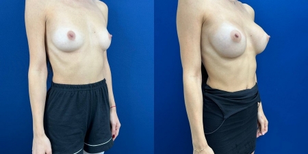 Увеличение груди до после – фото 42