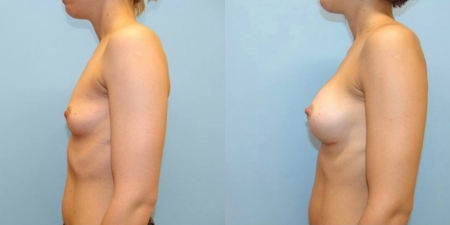 Увеличение груди до после – фото 62
