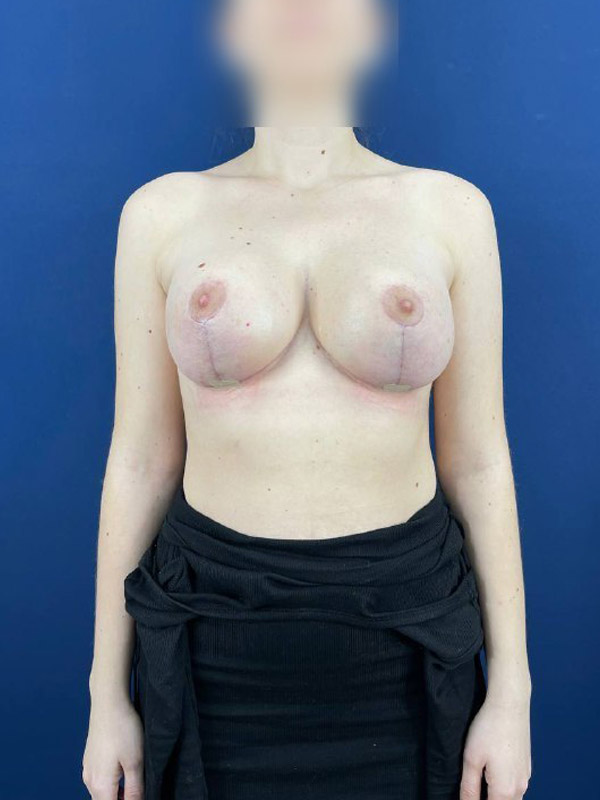 Подтяжка груди в Симферополе