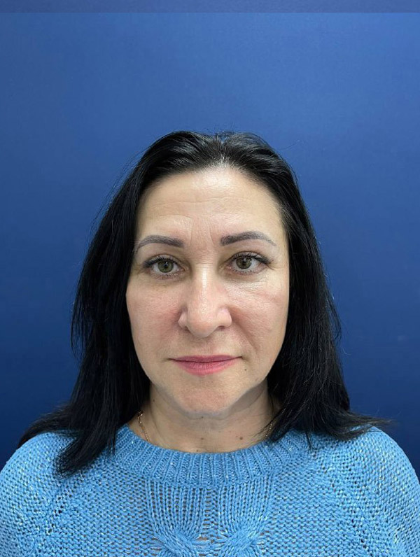 Липофилинг лица и блефаропластика в Симферополе – фото 36