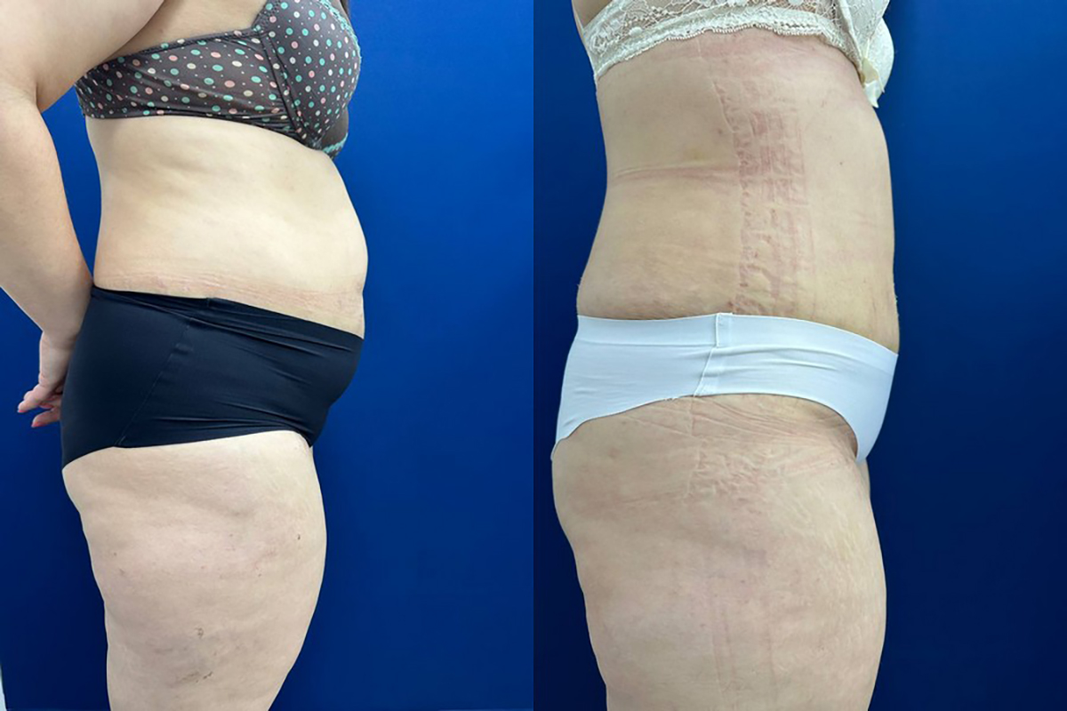 Операция по удалению большого живота Симферополь