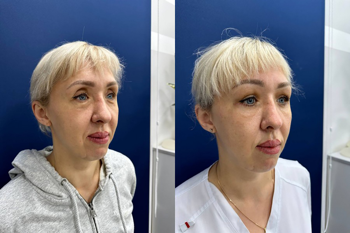 Липофилинг верхних век