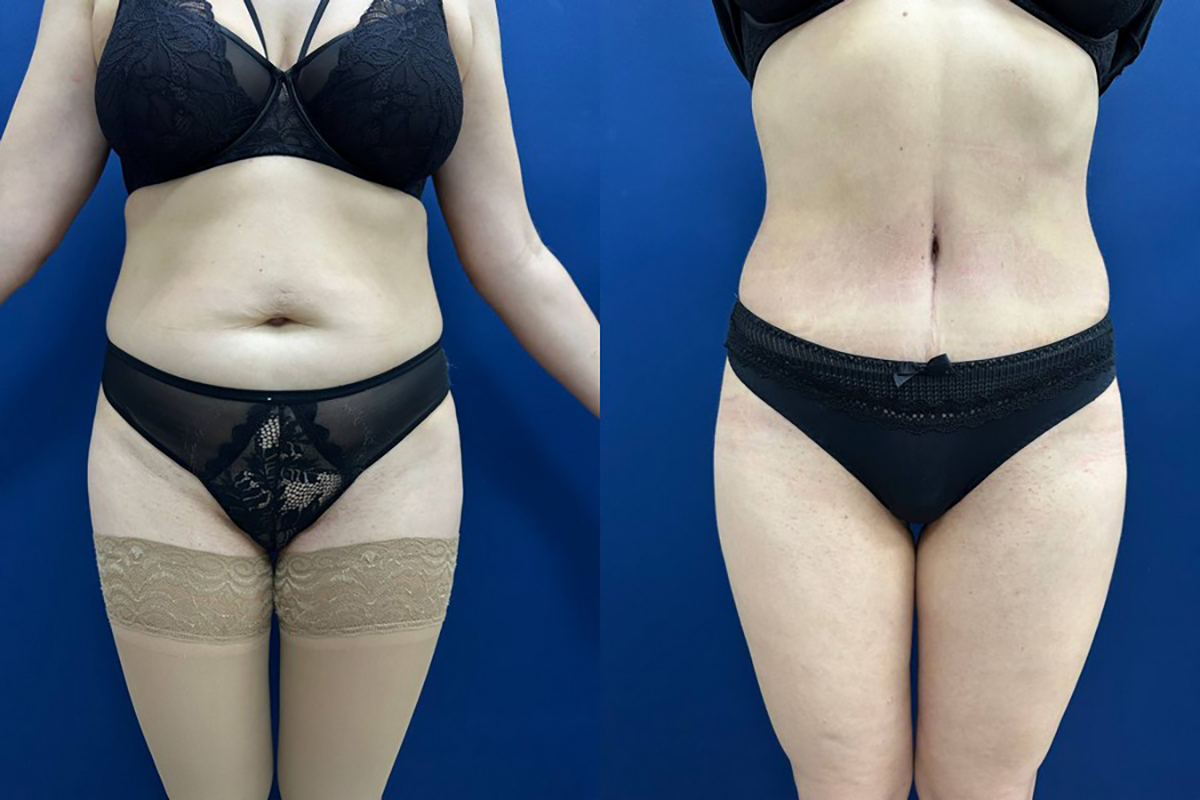 Цена операции убрать живот Симферополь