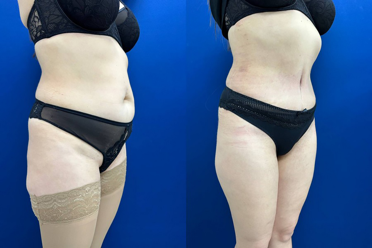 Операция убрать жир с живота Симферополь