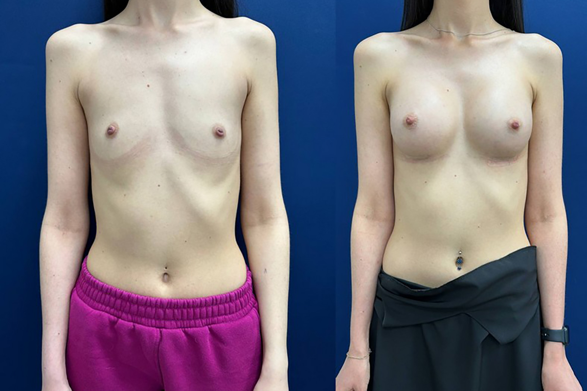 маммопластика симферополь отзывы