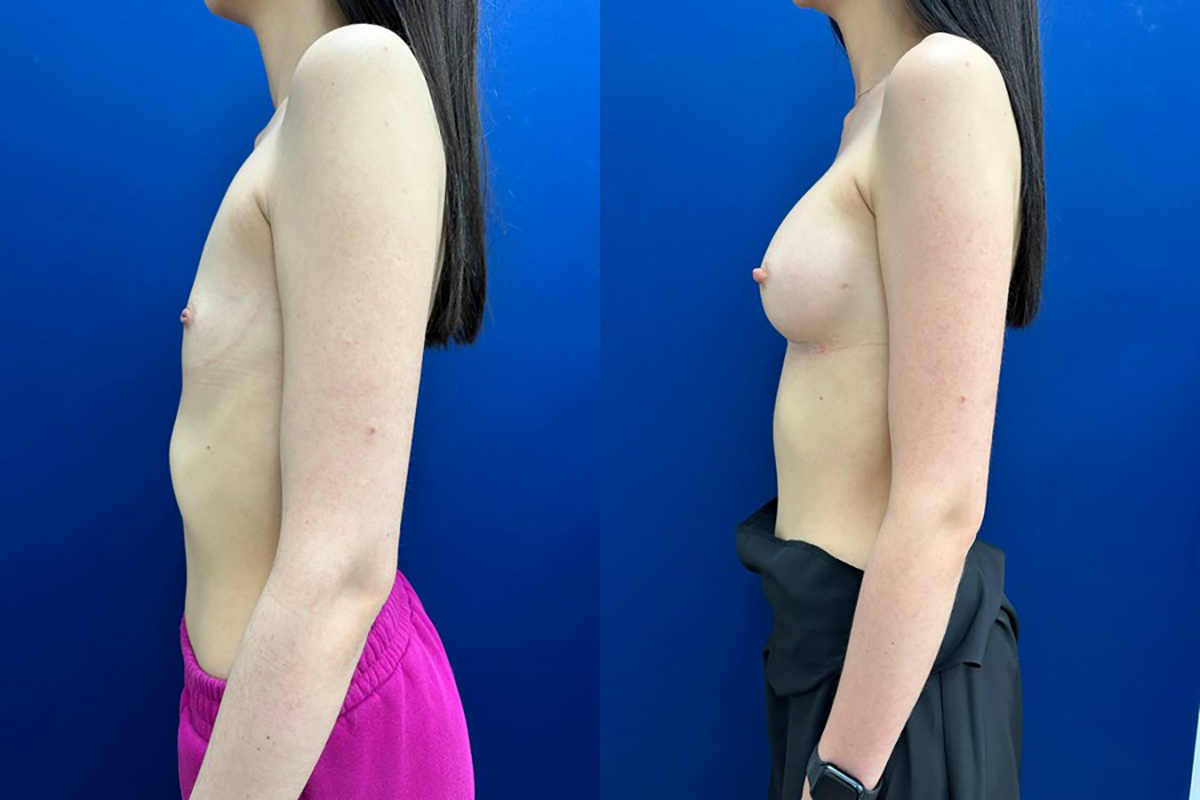 увеличение груди в симферополе цена