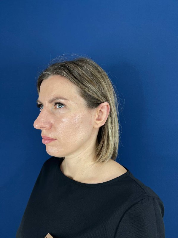 Сделать пластическую операцию на уши (отопластику) в Симферополе