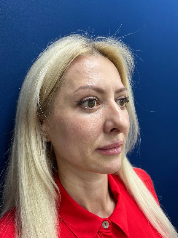 Круговая блефаропластика до и после операции