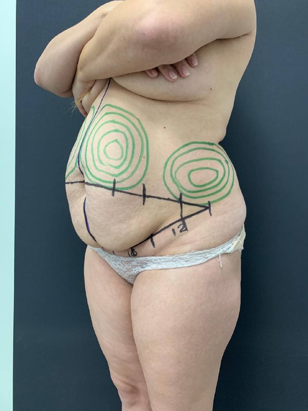 Операция удалить живот