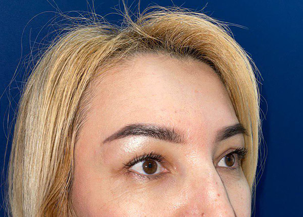 Цены на липофилинг лица в Симферополе