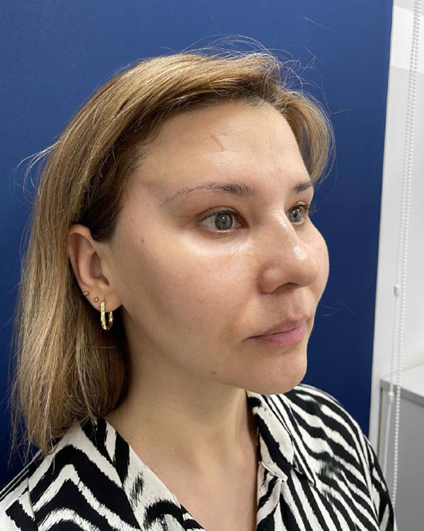 Круговая подтяжка лица в Симферополе отзывы