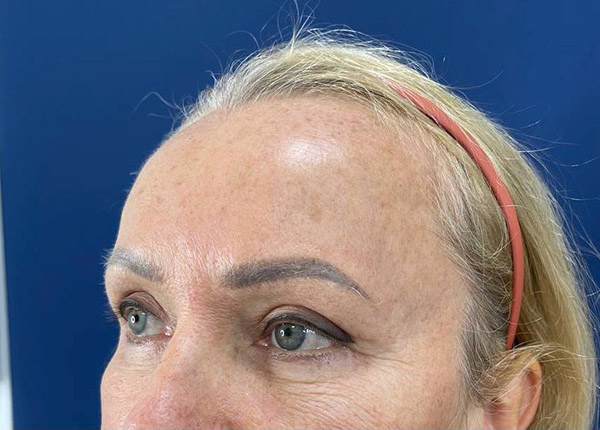 Операция круговая блефаропластика