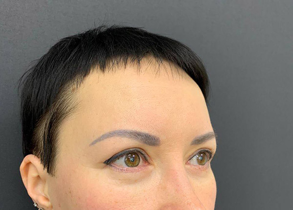 Блефаропластика в Крыму