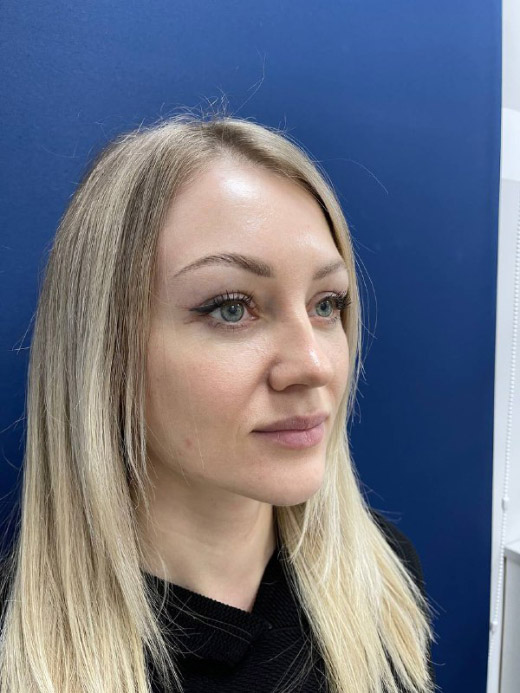 Круговая блефаропластика