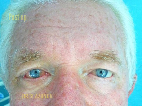 Лечение болезней век