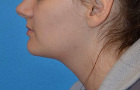 Фото липосакции шеи