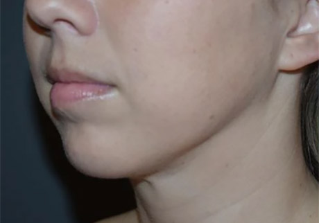 Липосакция шеи и подбородка