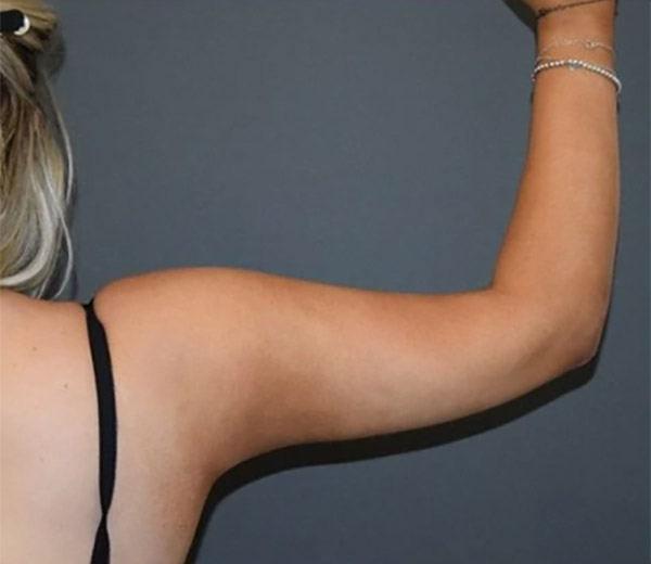 Стоимость липосакции рук