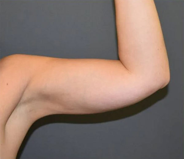 Сколько стоит липосакция рук