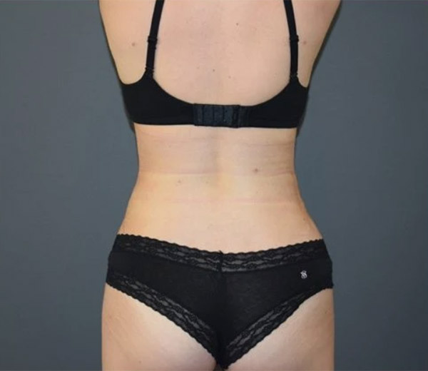 Липосакция спины