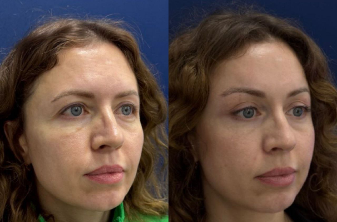 эндоскопическая подтяжка лица фото до после