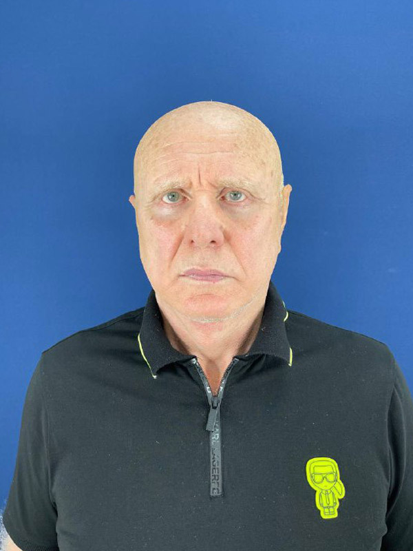 Операция SMAS-лифтинг лица