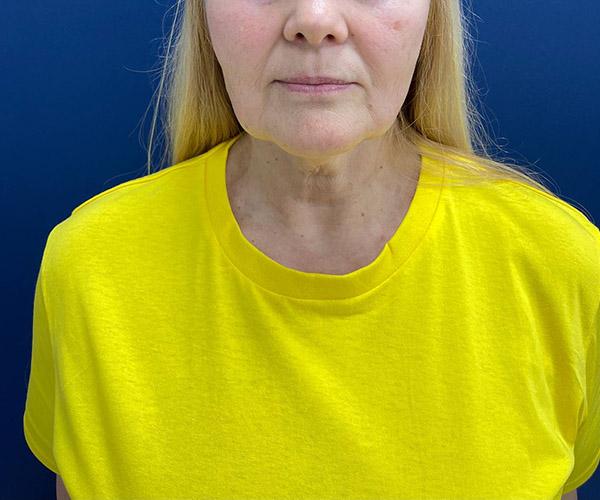 Отзывы об операции СМАС-лифтинг