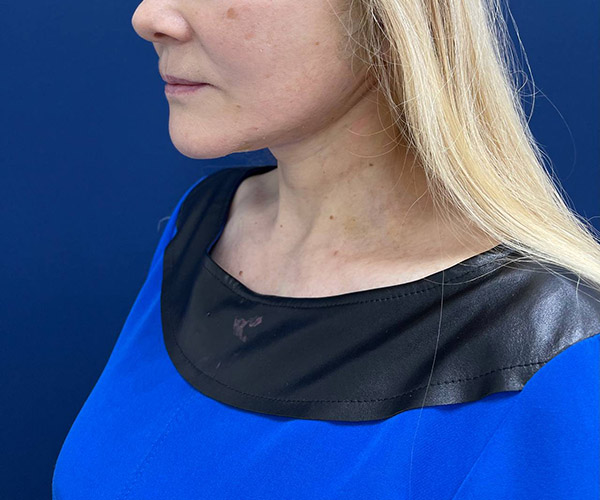 Пластическая операция СМАС-лифтинг