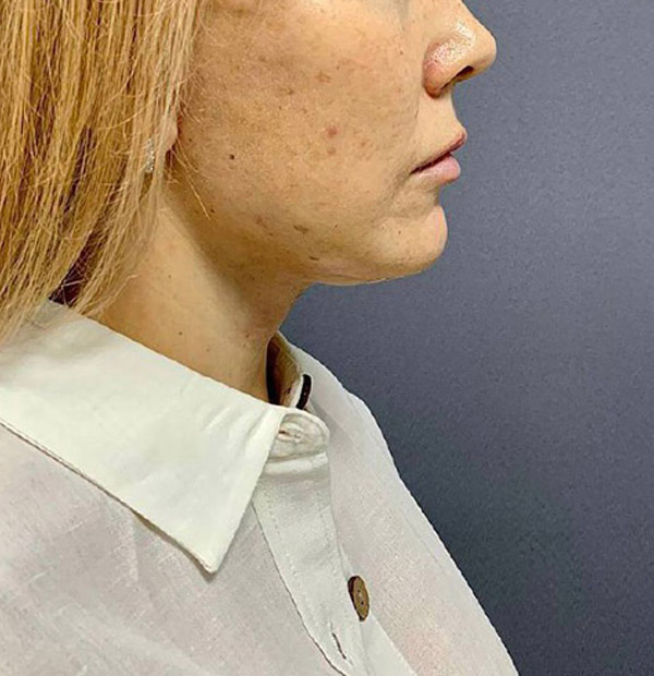 СМАС лифтинг: Подтяжка Нижних 2-3 лица и шеи